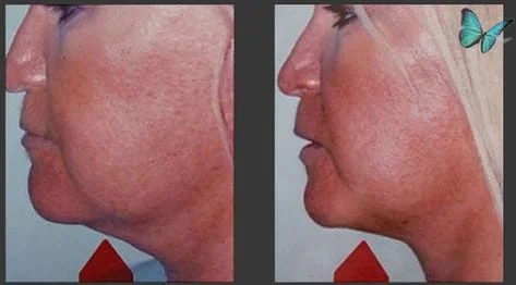Liposuction of the neck before after