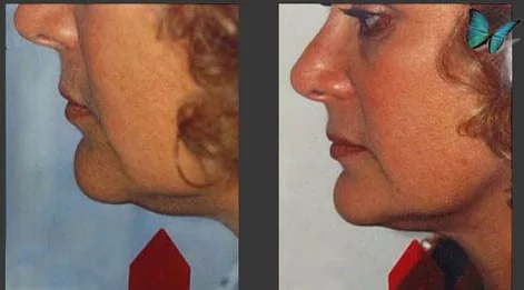 Liposuction of the neck before after
