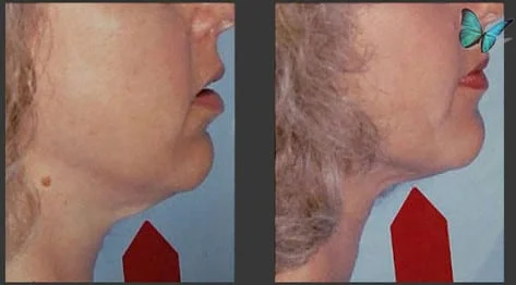 Liposuction of the neck before after