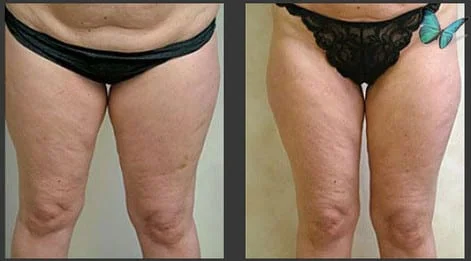 Liposuction of the thighs before and after photos