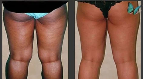 liposuction of thighs before and after