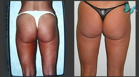 Liposuction Before and After
