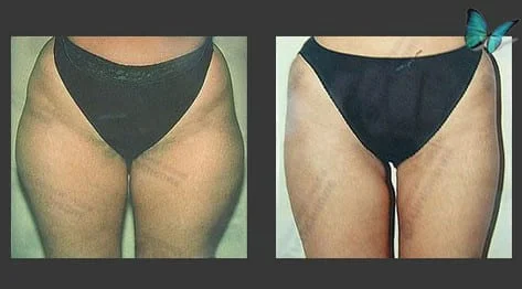 Liposuction Before and After
