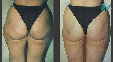 Liposuction Before and After