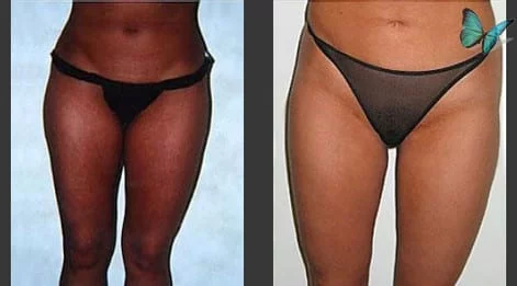 Liposuction Before and After