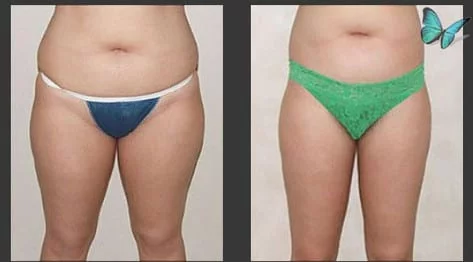 Liposuction Before and After