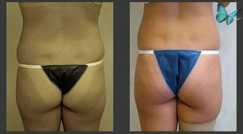 Liposuction Before and After