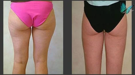 Liposuction Before and After