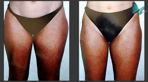Liposuction of the hips and thighs before and after photos