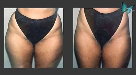 Liposuction of the hips and thighs before and after photos