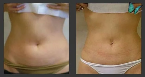 Liposuction Before and After Photos by Leading Los Angeles Plastic Surgeon in Beverly Hills Dr. Malcolm Lesavoy.