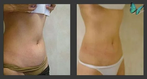 Liposuction Before and After Photos by Leading Los Angeles Plastic Surgeon in Beverly Hills Dr. Malcolm Lesavoy.