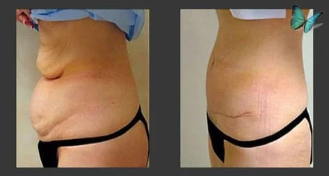 Tummy tuck before after photos by Dr. Malcolm Lesavoy Beverly Hills Plastic Surgeon.