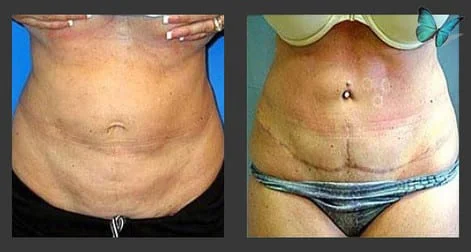 Tummy tuck before after photos by Dr. Malcolm Lesavoy Beverly Hills Plastic Surgeon.