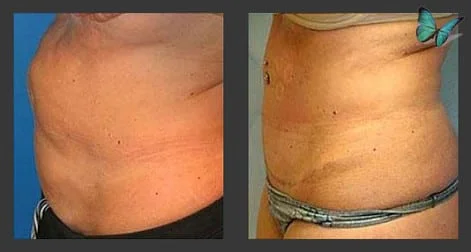 Tummy tuck before after photos by Dr. Malcolm Lesavoy Beverly Hills Plastic Surgeon.