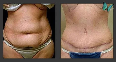 Tummy tuck before after photos by Dr. Malcolm Lesavoy Beverly Hills Plastic Surgeon.