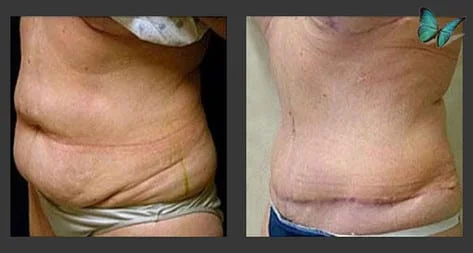 Tummy tuck before after photos by Dr. Malcolm Lesavoy Beverly Hills Plastic Surgeon.
