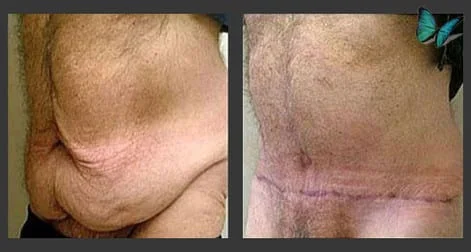 Male Tummy tuck before after photos by Dr. Malcolm Lesavoy Beverly Hills Plastic Surgeon.