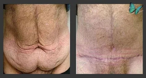 Male Tummy tuck before after photos by Dr. Malcolm Lesavoy Beverly Hills Plastic Surgeon.