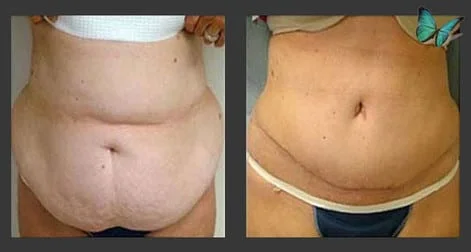 Tummy tuck before after photos by Dr. Malcolm Lesavoy Beverly Hills Plastic Surgeon.