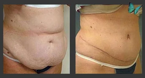 Tummy tuck before after photos by Dr. Malcolm Lesavoy Beverly Hills Plastic Surgeon.