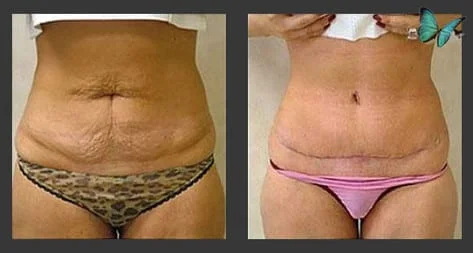 Tummy tuck before after photos by Dr. Malcolm Lesavoy Beverly Hills Plastic Surgeon.