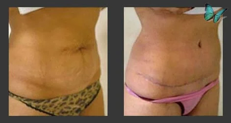 Abdominoplasty before and after photos.