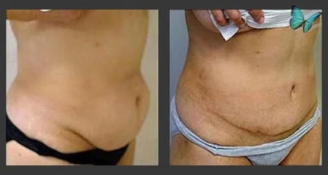 tummy tuck before after