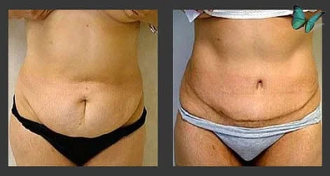 Tummy Tuck Before and After Photos by Dr. Malcolm Lesavoy Beverly Hills Plastic Surgeon.