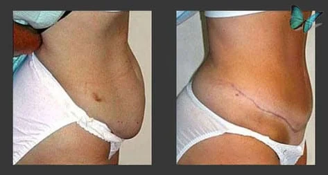 tummy tuck before after
