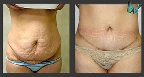 tummy tuck before after
