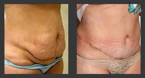 tummy tuck before after