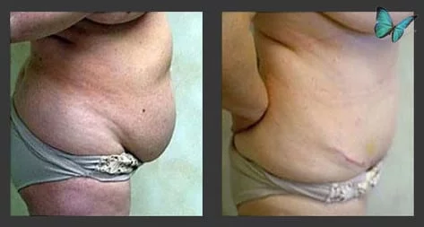 tummy tuck before after