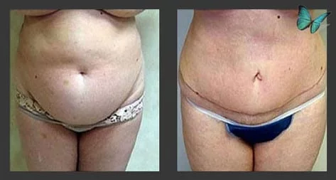 before after tummy tuck photos