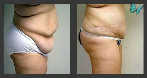 Before after tummy tuck photos Beverly Hills