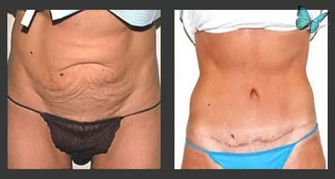 before after tummy tuck