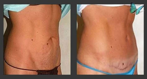 Beverly Hills Tummy Tuck before after photos