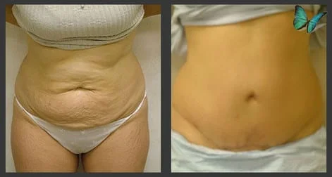 tummy tuck before after Beverly Hills