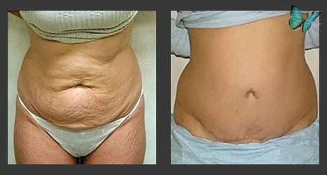 Best looking tummy tucks Beverly Hills