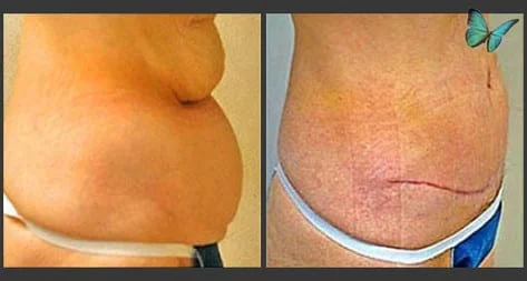 Best Looking Tummy Tuck results!