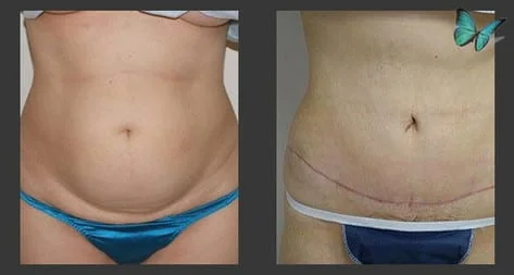 Best Looking Tummy Tuck results!