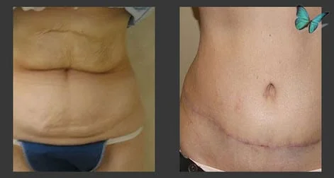 before after tummy tuck