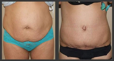 before after tummy tuck