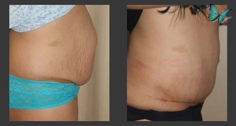 before after tummy tuck