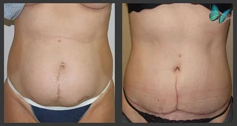 Before and after tummy tuck photos