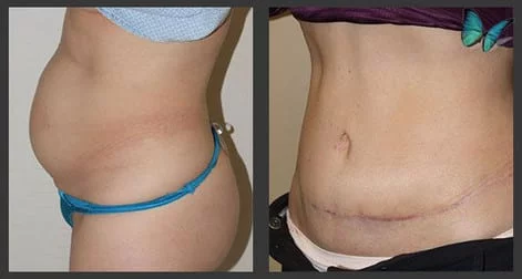 Before and after tummy tuck photos Beverly Hills plastic surgeon.