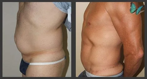 Before and after male abdominoplasty photos