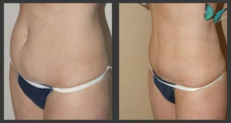 before after tummy tuck photos Beverly hills ca