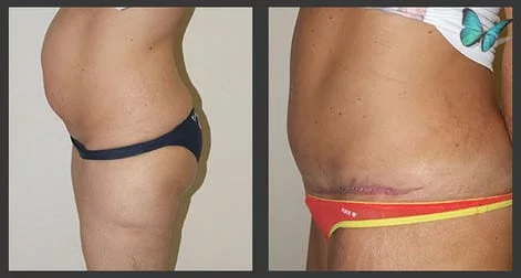 Before after tummy tuck photos