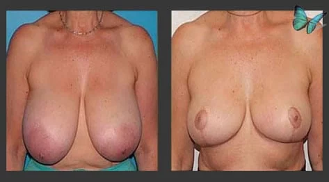 Breast Lift & Reduction Before and After with reduction and restoration of enlarged nipples.